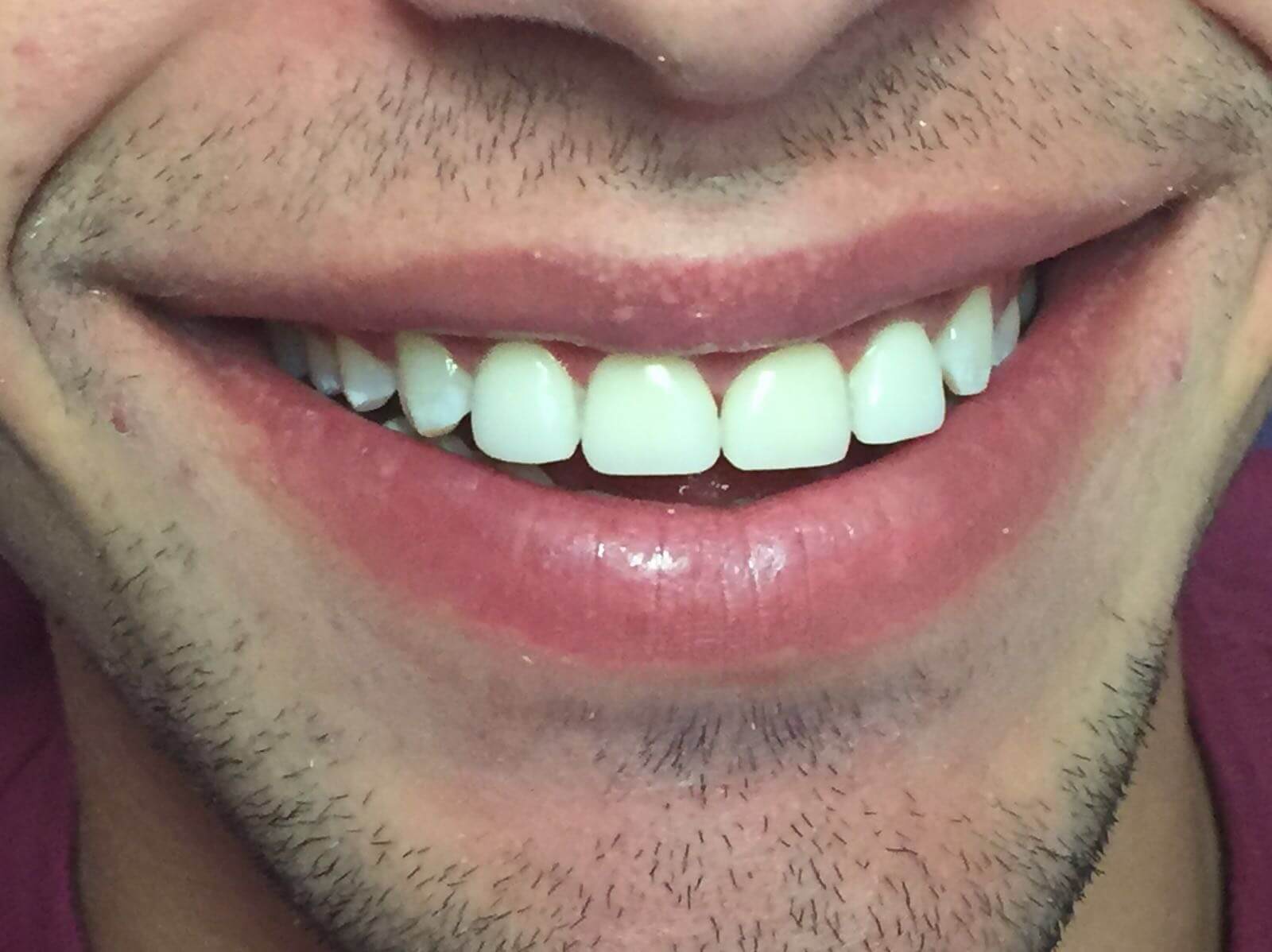 carillas dentales estética dental Valls