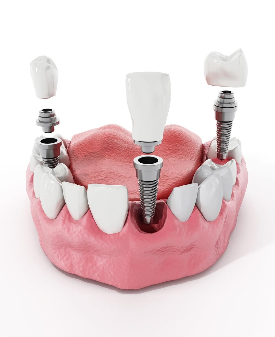 implantes dentales