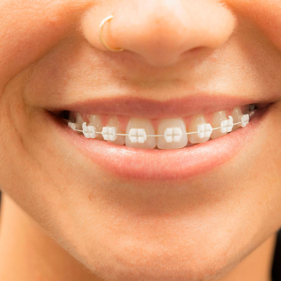 ortodoncia dental en Valls