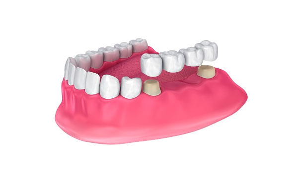 implante dentales en Valls Clínica Dental