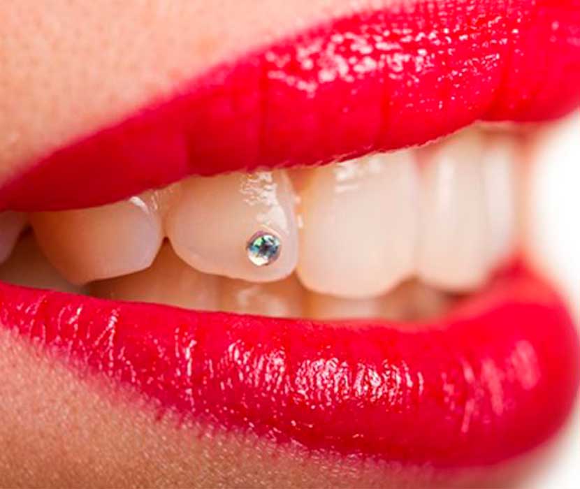 Estética dental clínica Dental Valls