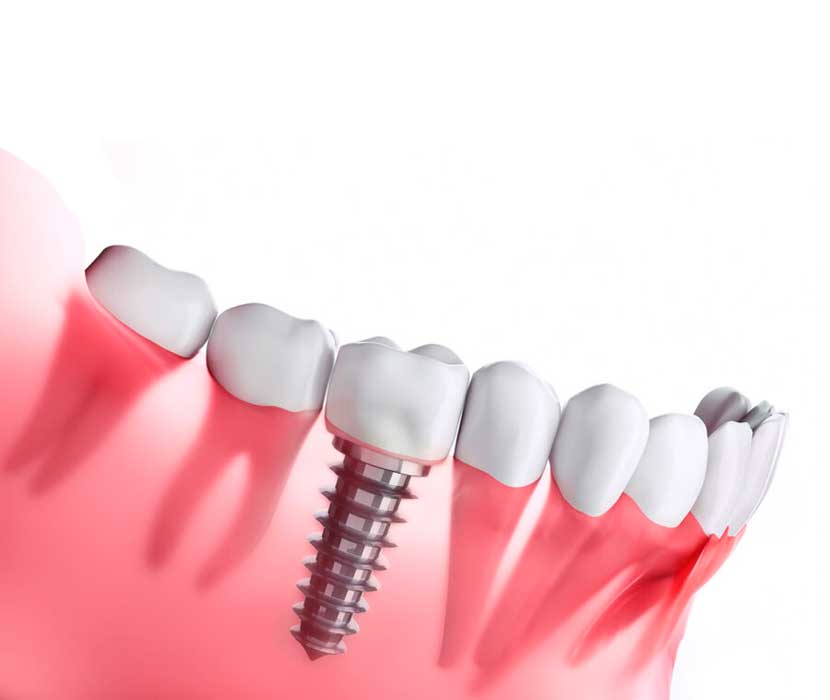 Implantes dentales en Valls