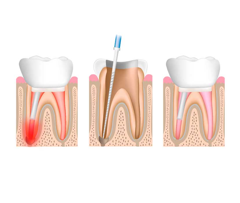 restauración dientes y muelas