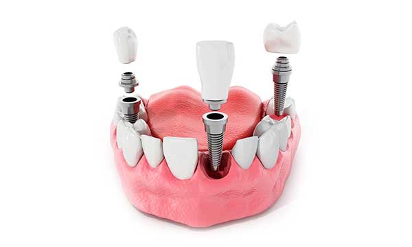 Dentista en Valls